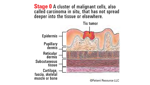Skin Cancer Staging